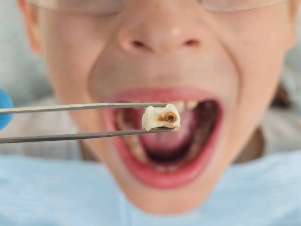 Best Broken or Cracked Tooth Emergency Dentist in Newcomerstown, OH